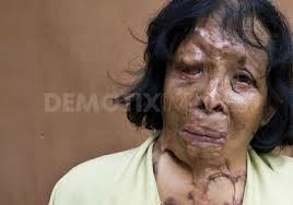 A close-up photograph of an Asian woman with severe facial and neck scarring, likely from an acid attack, against a plain brown background. A Demotix watermark is visible across the center.
