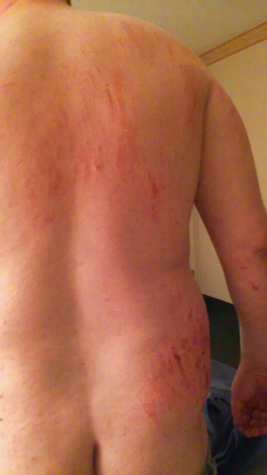 A photograph of a person's back and hip showing extensive red scratches and abrasions, likely documenting physical injuries.